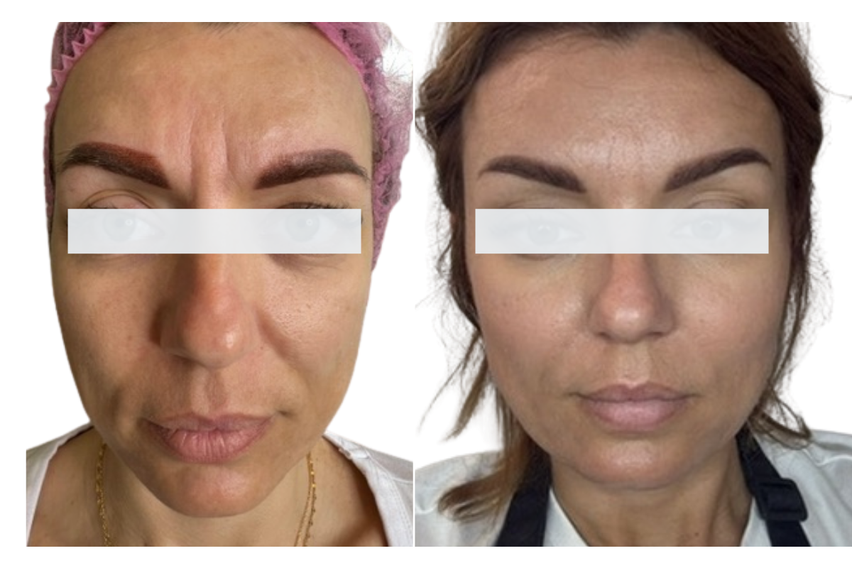 Full Face prije i poslije